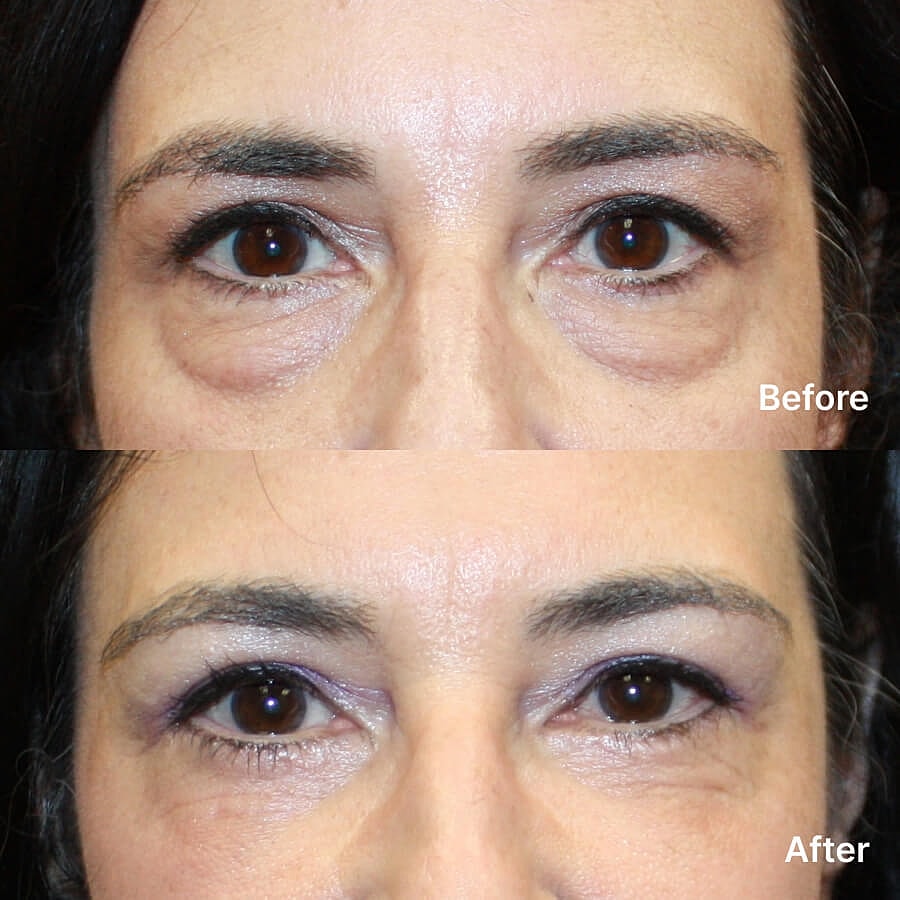 Blepharoplasty Before & After