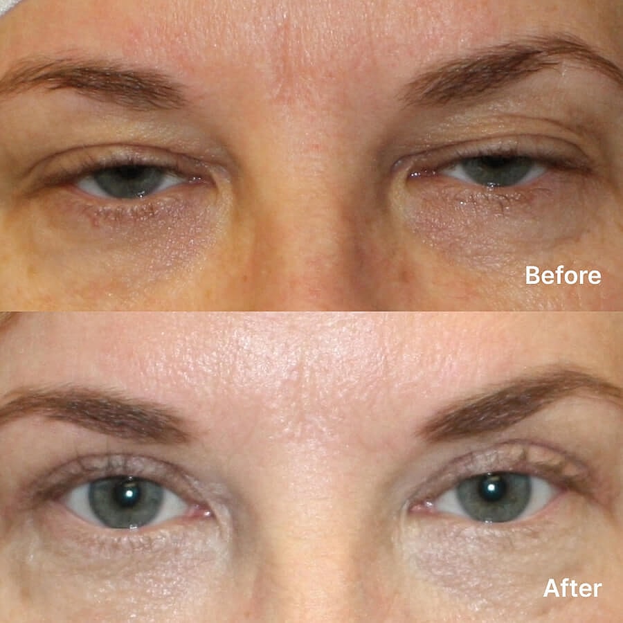 Blepharoplasty Before & After