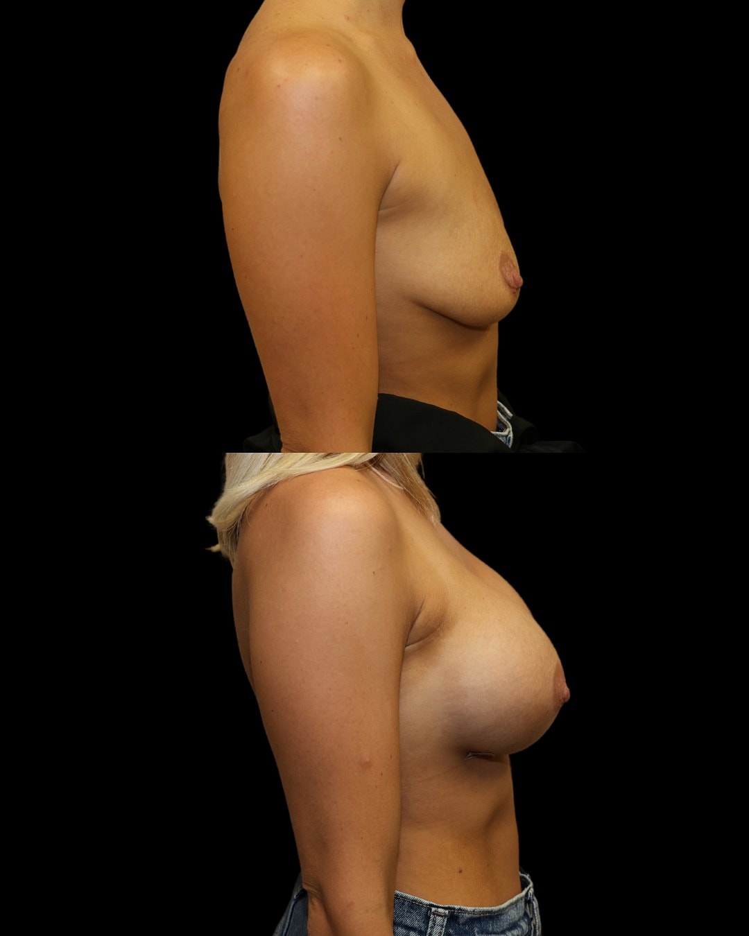 Breast Augmentation Before & After