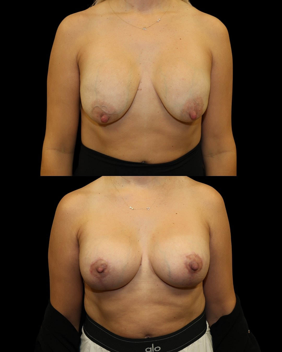 Breast Augmentation Before & After