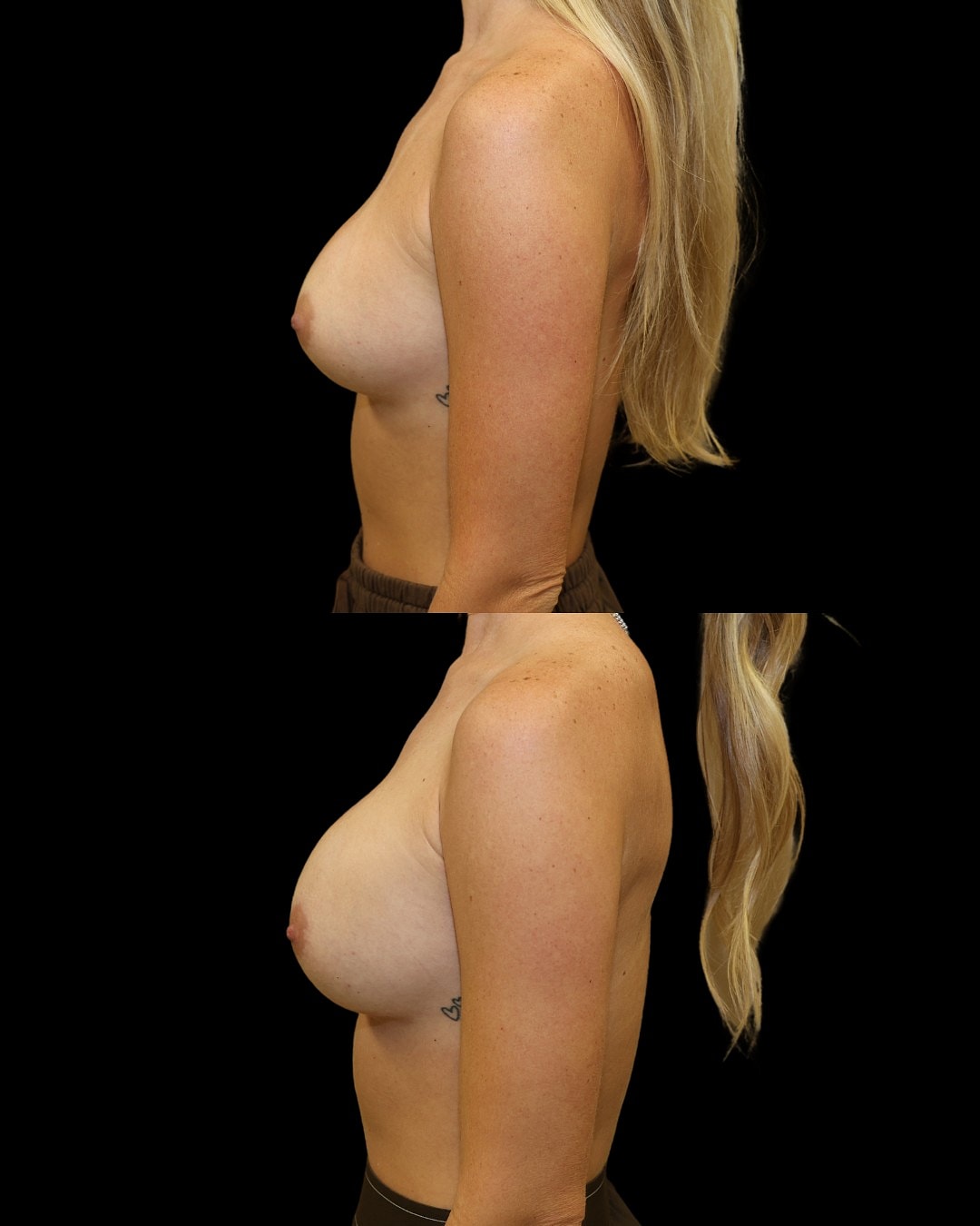 Breast Augmentation Before & After