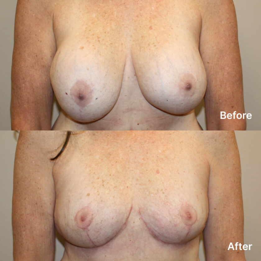 mastopexy-removal-front