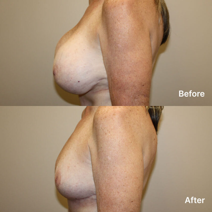 mastopexy-removal-left